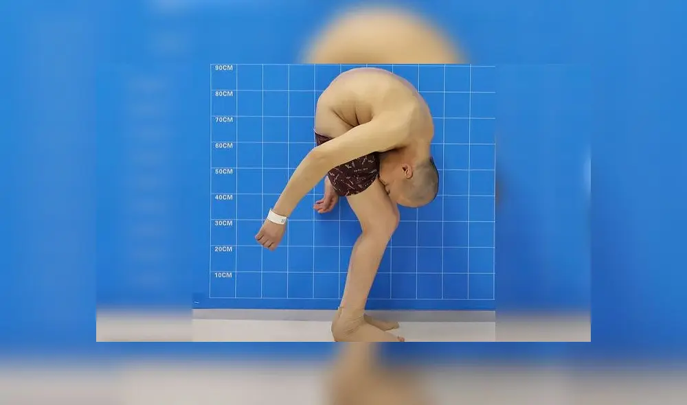 Tuvo el cuerpo doblado por casi tres décadas y volvió a la normalidad gracias a operación [FOTOS]