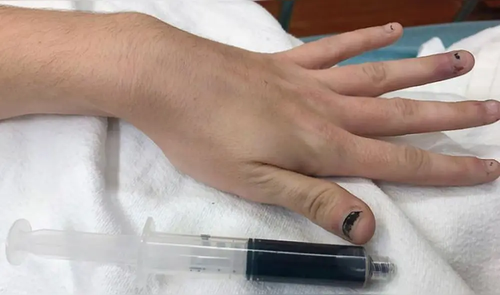 Los medicamentos que tomó la joven tenían benzocaína, componente químico que afectó en la oxigenación de sus tejidos. Foto: New England Journal of Medicine Los medicamentos que tomó la joven tenían benzocaína, componente químico que afectó en la oxigenación de sus tejidos. Foto: New England Journal of Medicine