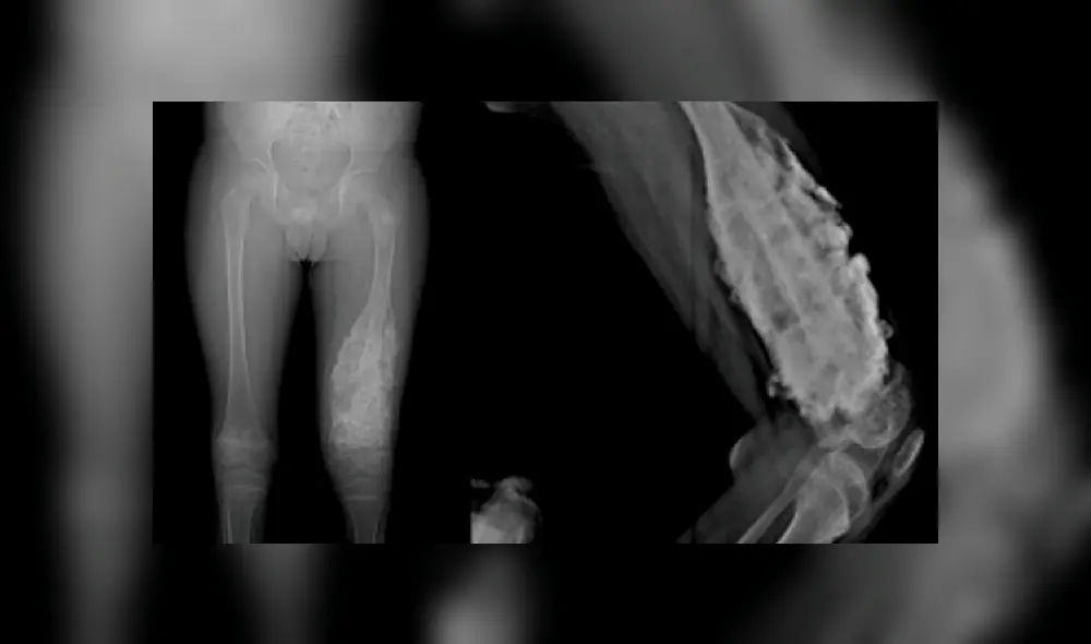 Osteosarcoma: el cáncer de huesos más común durante la infancia Osteosarcoma: el cáncer de huesos más común durante la infancia