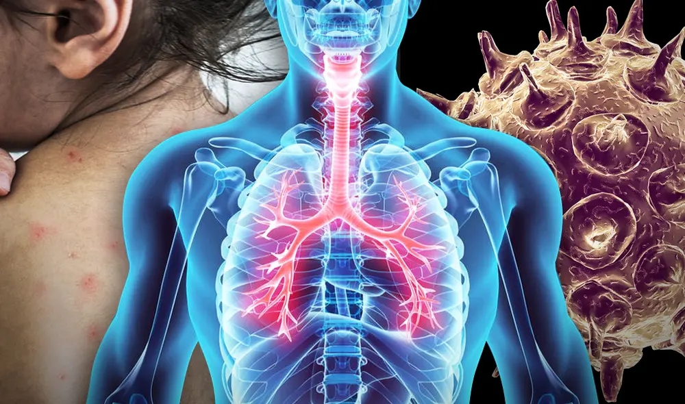 Enfermedades infecciosas - virus - contagio viral. Foto: Composición LR