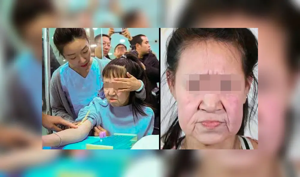 La cirugía tuvo una duración de siete horas y media el 29 de diciembre, los médicos le quitaron el exceso de piel y le corrigieron la nariz, la boca y las cejas. (The Sun) La cirugía tuvo una duración de siete horas y media el 29 de diciembre, los médicos le quitaron el exceso de piel y le corrigieron la nariz, la boca y las cejas. (The Sun)