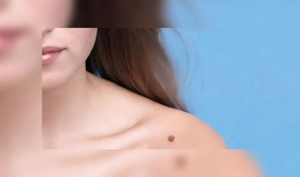 Día del Lunar: ¿cómo detectar y prevenir a tiempo las inusuales manchas en la piel? Día del Lunar: ¿cómo detectar y prevenir a tiempo las inusuales manchas en la piel?