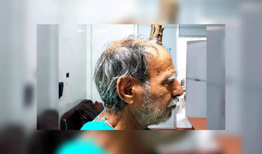 Shyam Lal Yadav sufrió un golpe y le comenzó a crecer un cuerno en la cabeza. Foto: difusión
