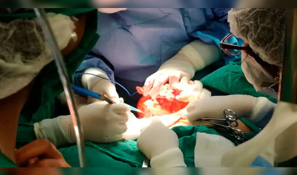 Médicos cusqueños lograron extirpar tumor gigante de mama