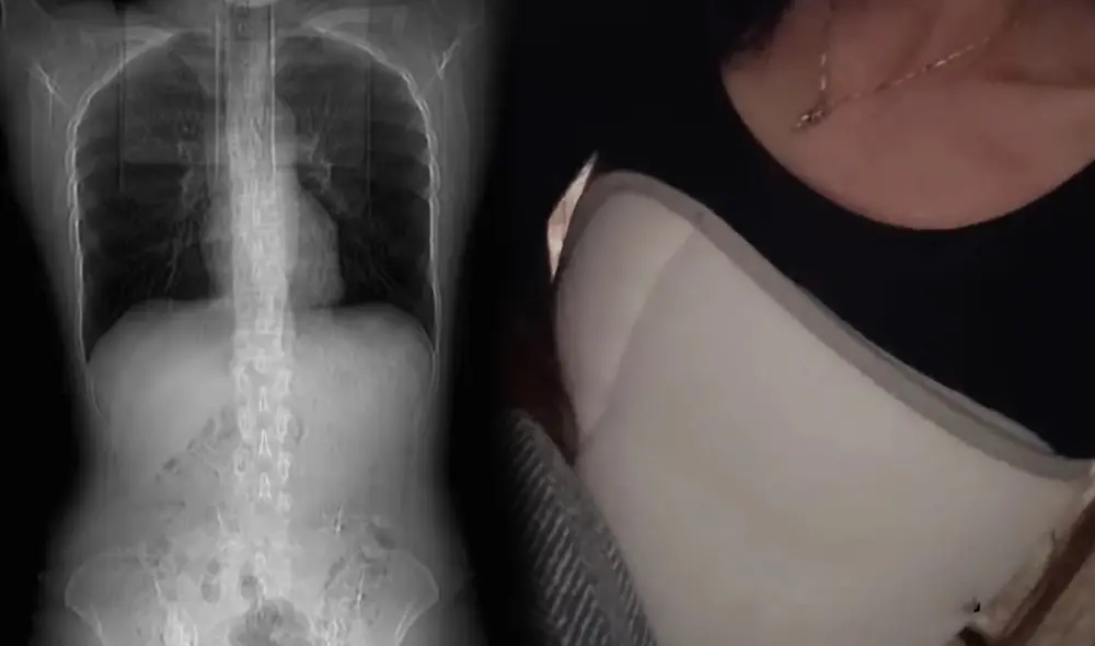 Debido a sus cuatro costillas rotas deberá pasar un mes en descanso y permanecer vendada. Foto: composición LR/ South China Morning Post. Debido a sus cuatro costillas rotas deberá pasar un mes en descanso y permanecer vendada. Foto: composición LR/ South China Morning Post.