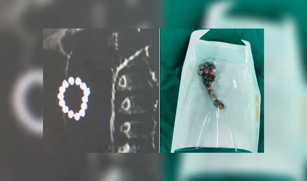 Bebé se tragó 14 bolitas magnéticas que le generaron severas lesiones