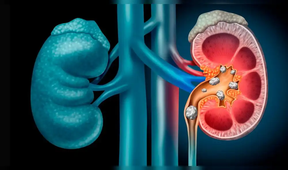 Día Mundial del Riñón: ¿Por qué se celebra esta fecha?