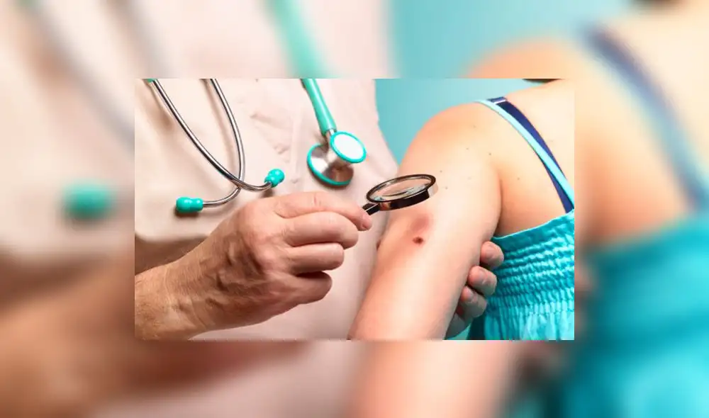 Cusco: Organizan campaña gratuita para detectar casos de cáncer de piel  