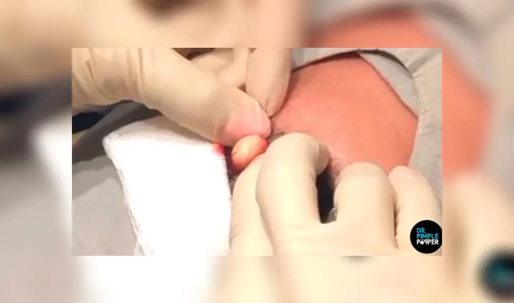 Le extirpan enorme quiste de su cuero cabelludo y lo abren para ver su interior [VIDEO]