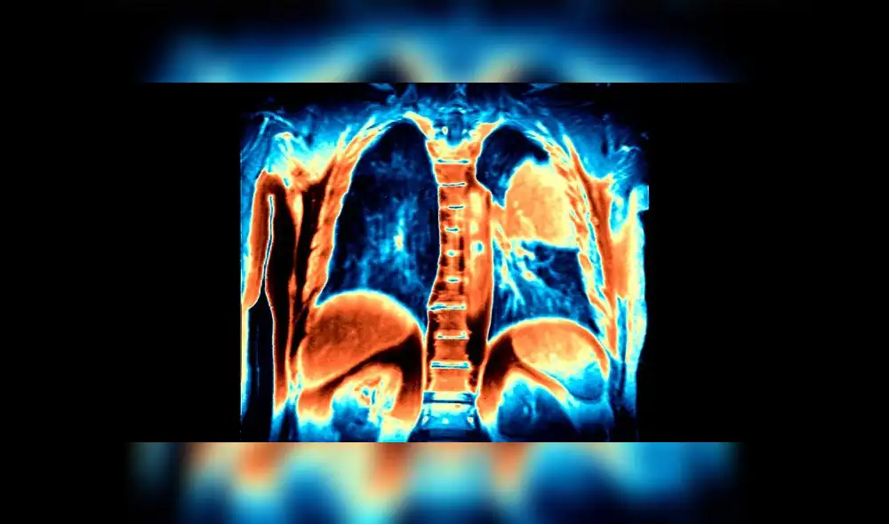 La inmunoterapia ha sido incluida en el tratamiento de cáncer de pulmón. Imagen referencial: resonancia magnética de los pulmones muestra los tumores (naranja) en el lado derecho. Science Source.