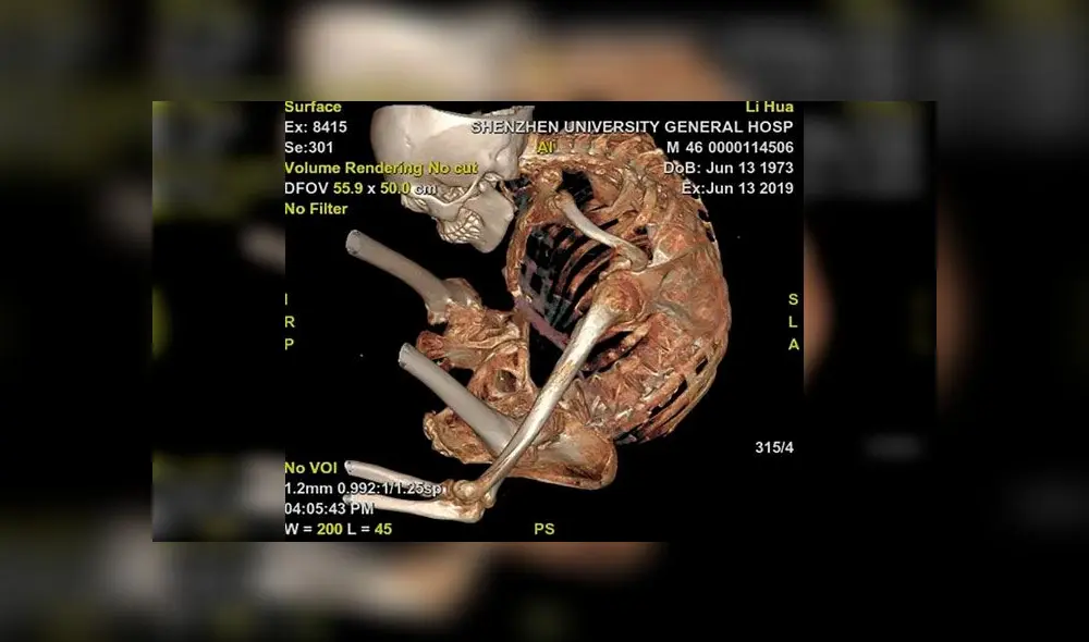 Tuvo el cuerpo doblado por casi tres décadas y volvió a la normalidad gracias a operación [FOTOS]