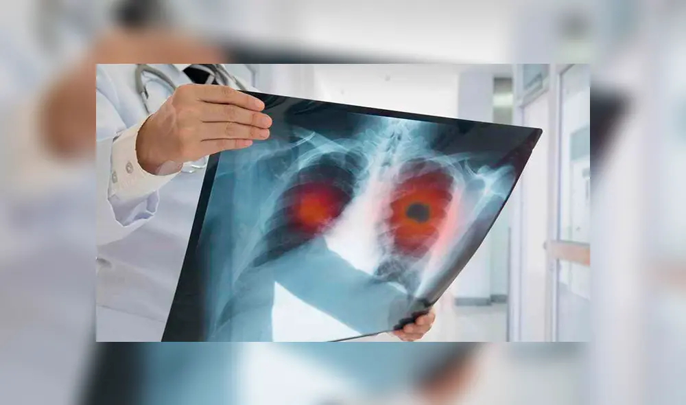 Científicos hallan nuevo subtipo de cáncer de pulmón muy agresivo y que no se halla relacionado con el consumo de tabaco. Foto: Difusión Científicos hallan nuevo subtipo de cáncer de pulmón muy agresivo y que no se halla relacionado con el consumo de tabaco. Foto: Difusión