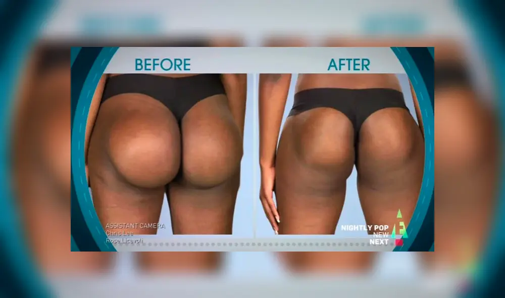 Mujer gastó 4 mil dólares por implantes de glúteos, pero el resultado fue desastroso [FOTOS]