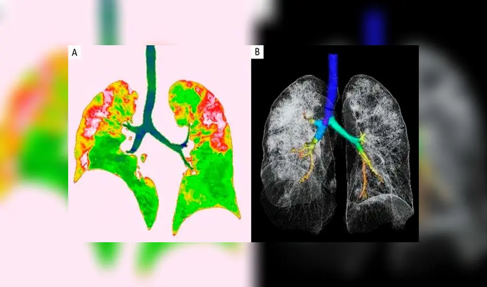 Tomografías muestran el daño que causa el coronavirus en los pulmones [FOTOS]