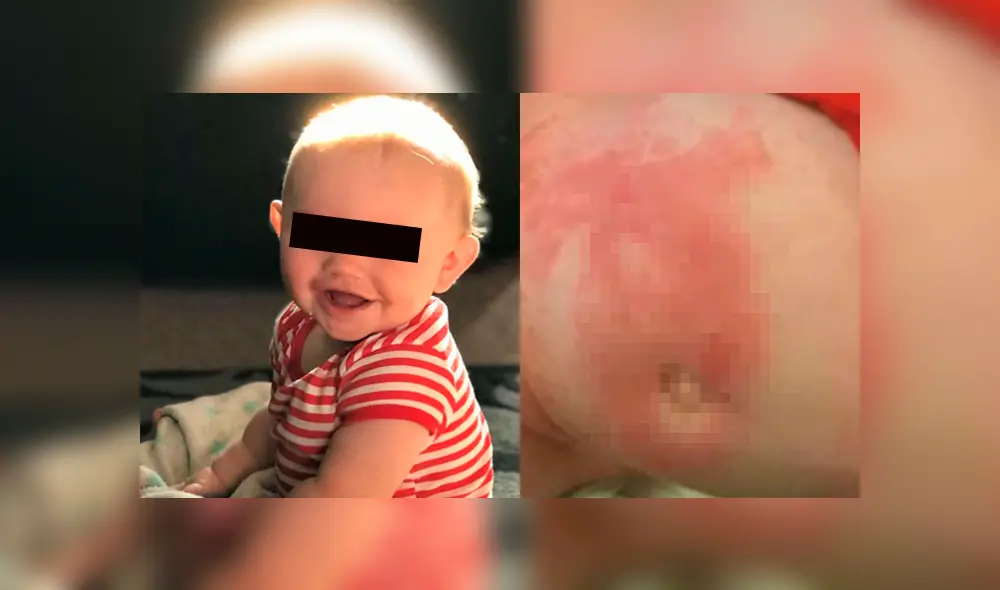 Bebé queda con heridas abiertas en la piel tras ‘quemaduras’ de su pañal Bebé queda con heridas abiertas en la piel tras ‘quemaduras’ de su pañal