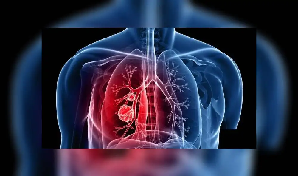 Cáncer pulmón COVID-19. Foto: Difusión