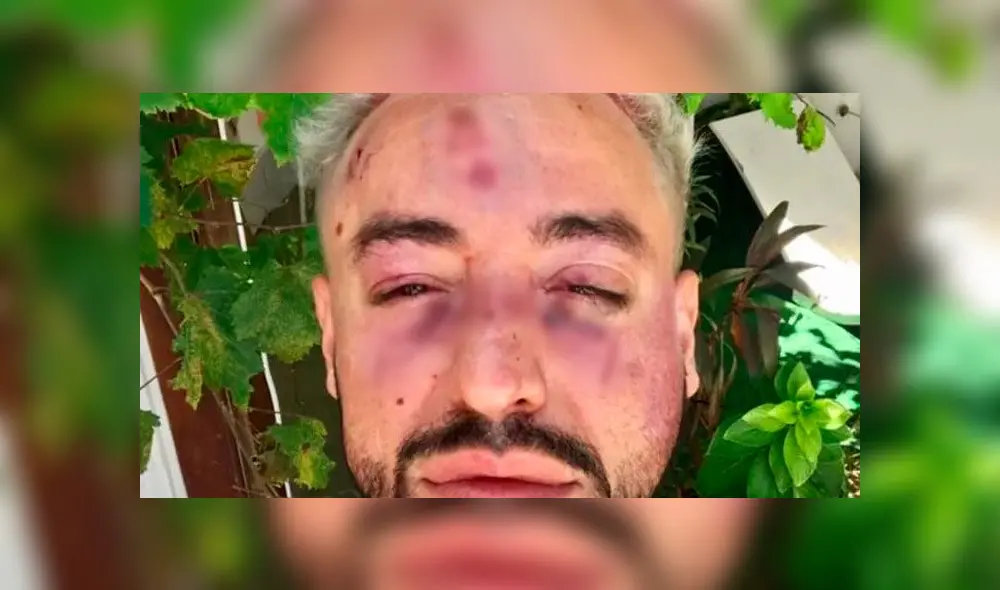 Hombre denuncia que sufrió agresión homofóbica: “Eran más de 15 jóvenes pegándome” [FOTO]