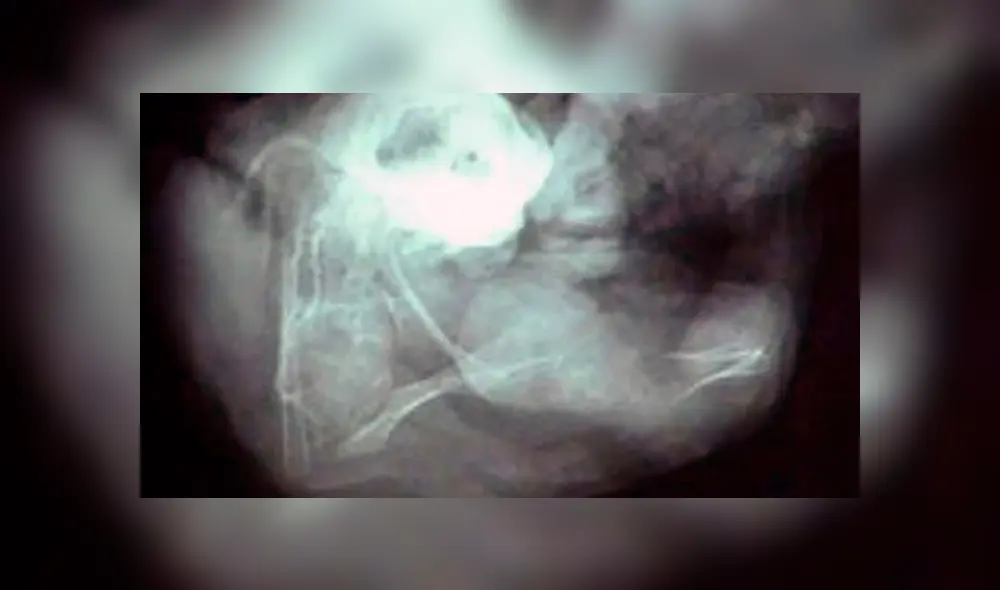 Niña de 7 años fue operada para extirpar el feto de su hermano que llevaba en la espalda Niña de 7 años fue operada para extirpar el feto de su hermano que llevaba en la espalda