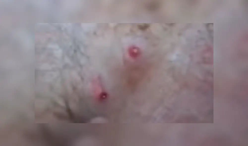 Facebook viral: misteriosas criaturas vivían dentro de la espalda de un joven sin que él lo sepa [VIDEO]