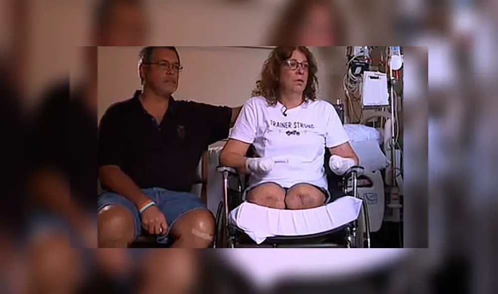 Mujer pierde brazos y piernas luego de que su mascota le lamiera una herida [VIDEO]