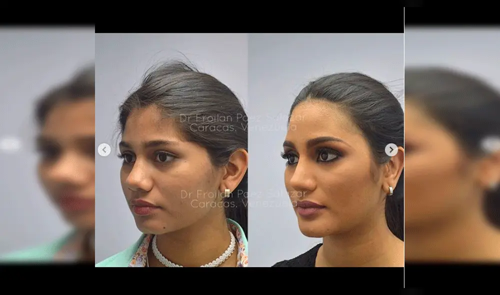 Filtran inéditas imágenes de Miss Venezuela antes de operaciones en el rostro