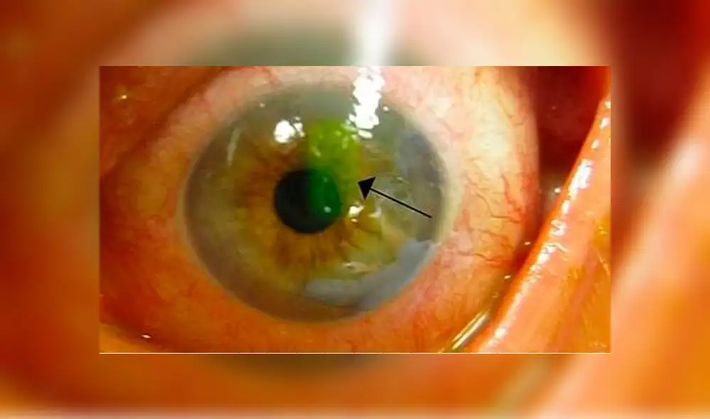 Médicos encuentran cuatro abejas vivas dentro del ojo de una mujer [FOTOS]
