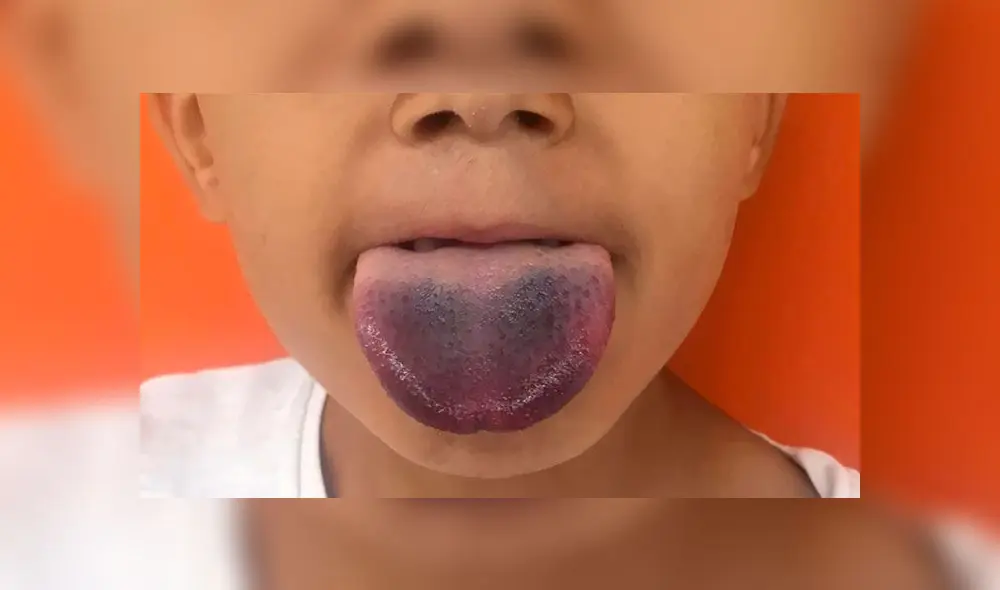 Lengua de un niño se atora en una botella Lengua de un niño se atora en una botella