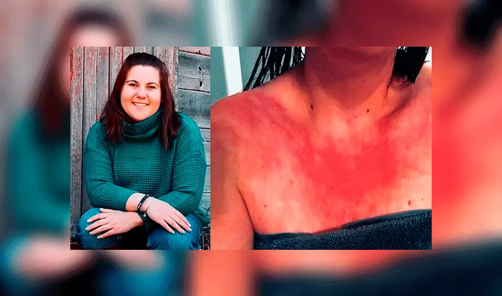 Mujer alérgica al agua consume analgésicos antes de bañarse y solo puede beber medio vaso. Foto: Daily Mail