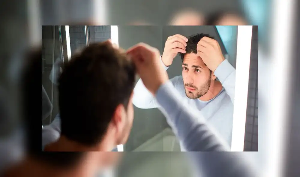 Los hombres suelen ser quienes más padecen la alopecia. Foto: difusión Los hombres suelen ser quienes más padecen la alopecia. Foto: difusión