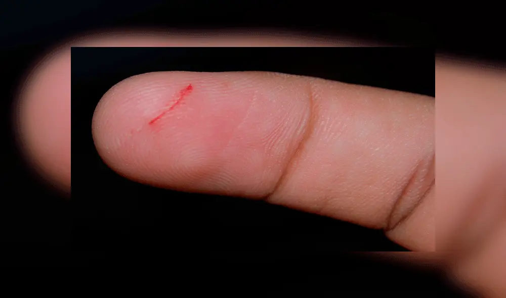 Contrajo bacteria carnívora al cortarse con un papel y quedó cerca de morir