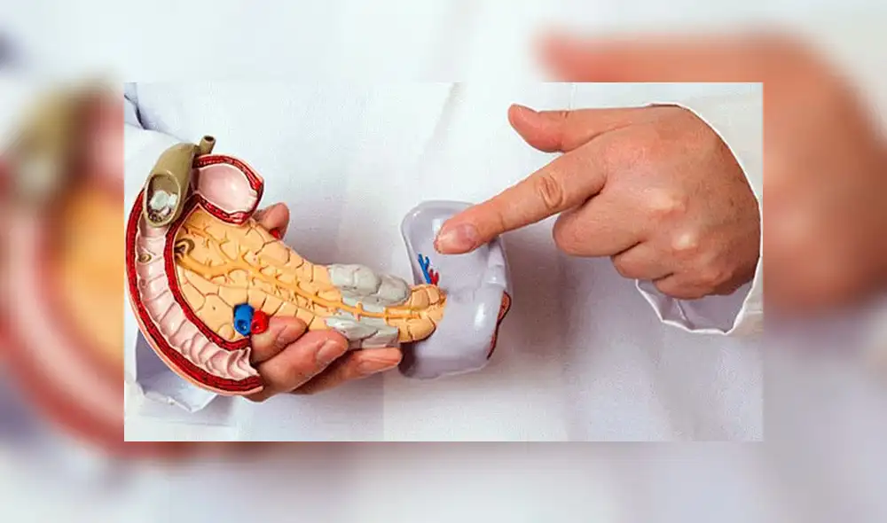 Síntomas del cáncer de páncreas se presentan en etapa avanzada Síntomas del cáncer de páncreas se presentan en etapa avanzada