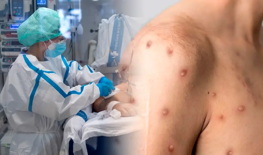 La viruela del mono, conocida también como viruela símica, es una zoonosis viral. Foto: AFP/El País La viruela del mono, conocida también como viruela símica, es una zoonosis viral. Foto: AFP/El País