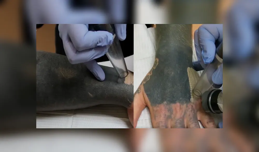 Facebook viral: joven decide quitarse tatuaje del brazo, sin imaginar el terrible resultado que tendría