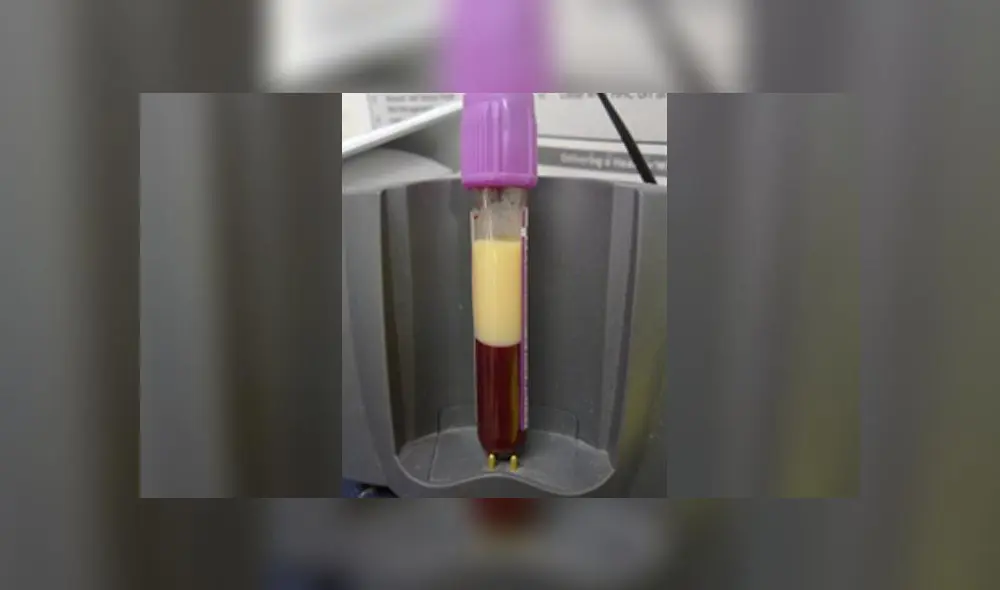 Médicos alemanes extraen ‘sangre blanca’ a paciente por el exceso de grasa que tenía