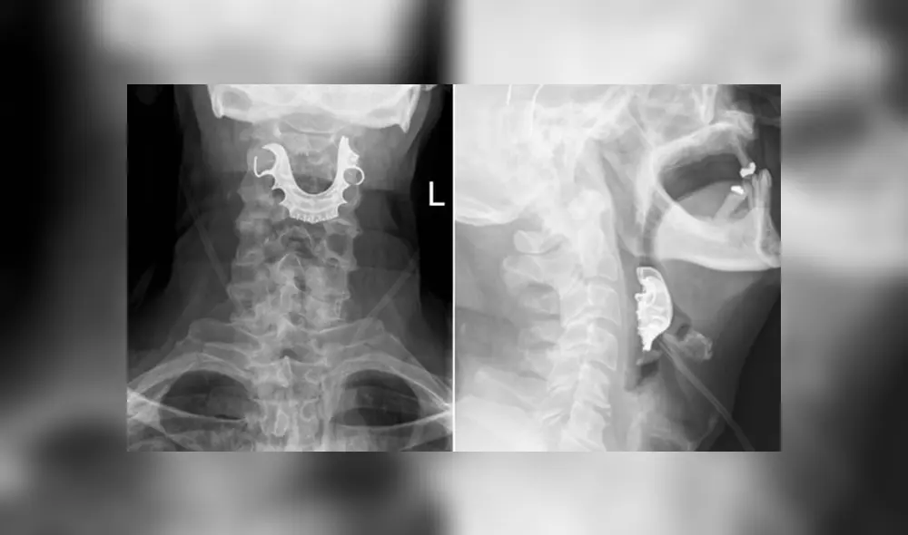 Dentadura se quedó atorada en garganta de anciano. Foto:  Harriet A Cunniffe (BMJ)