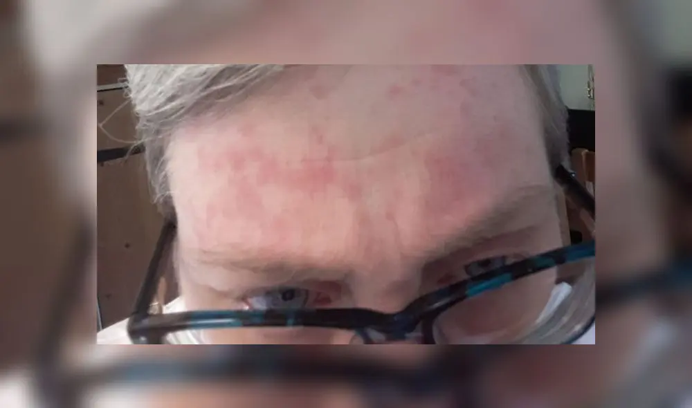 Un globo la rozó y la dejó en cuidados intensivos: la mujer que ‘sobrevive’ al látex [FOTOS] 