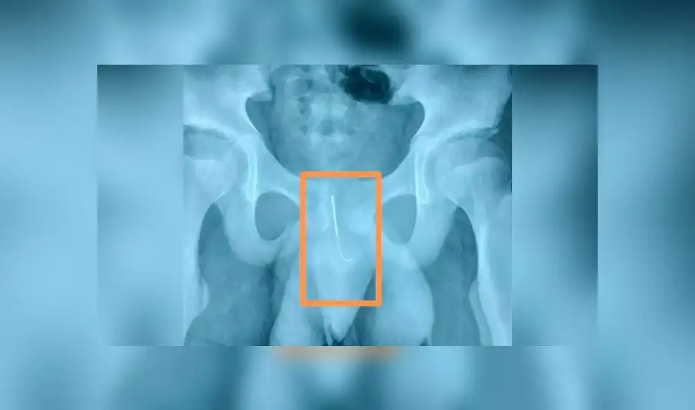 La aguja de 10 cm podía dañar su vejiga o destruir arterias. Foto: AsiaWire.