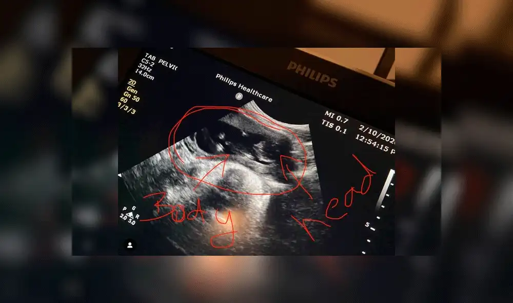 La ecografía que muestra a la segunda bebé de Kayden. Foto: Mercury Press & Media.