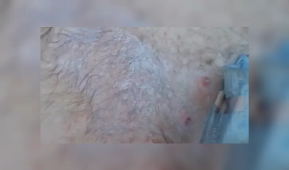 YouTube viral: joven va al médico por roncha en su espalda y le hacen espeluznante hallazgo [VIDEO]