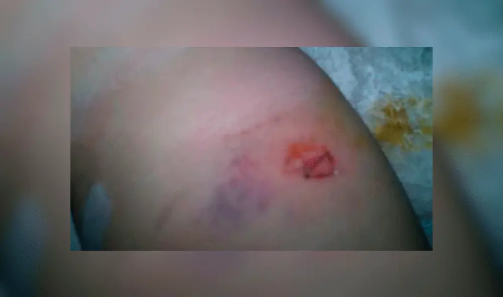 Médicos ignoraron herida por bala de un bebé y solo lo trataron como “mordedura” [FOTOS]