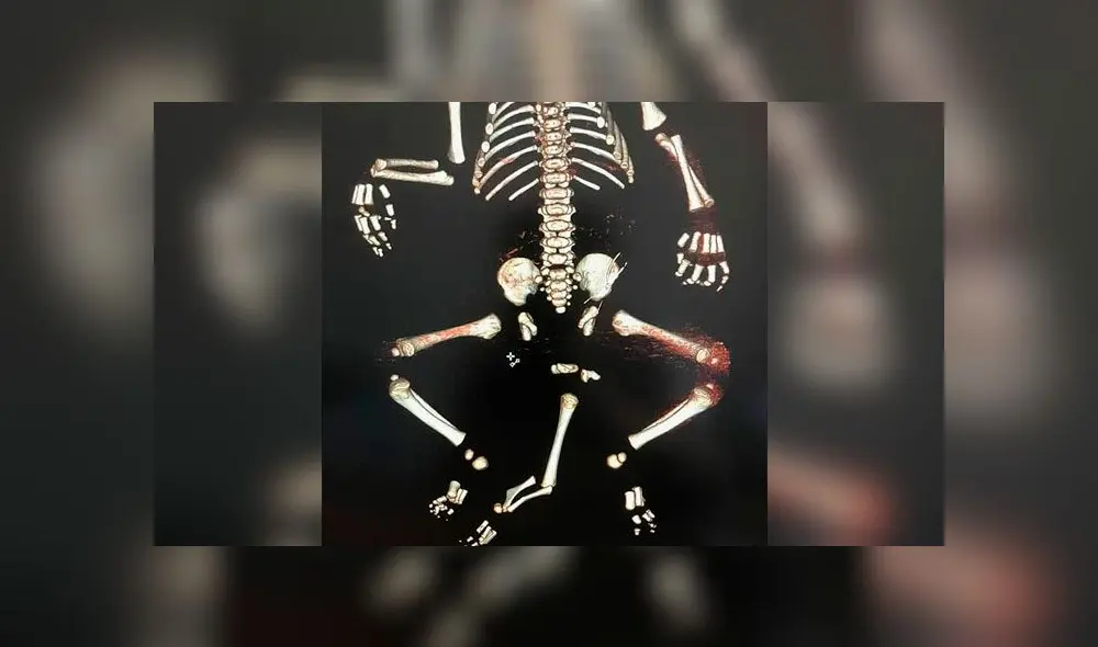 Médicos salvan la vida de un bebé que nació con tres piernas, dos genitales y sin ano [FOTOS]