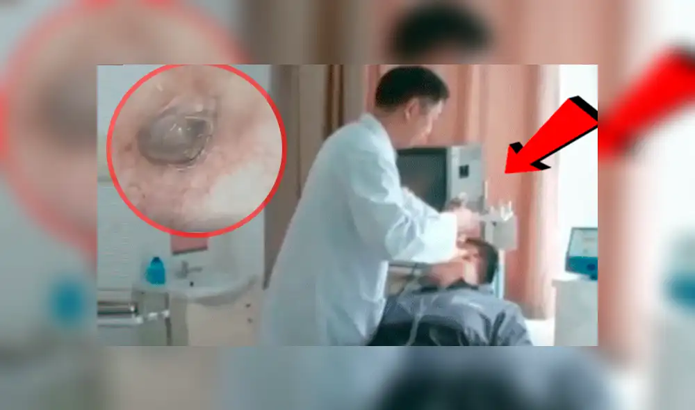 YouTube viral: médico revisa oído de joven y encuentra terrorífica criatura en su interior [VIDEO]