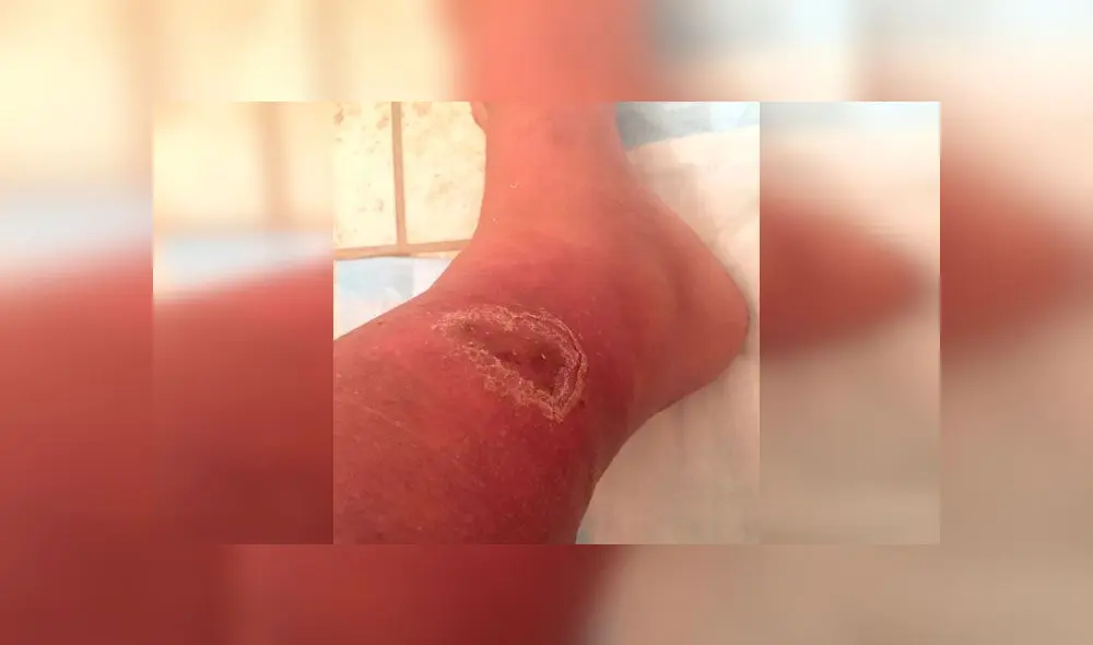 Mujer acaba con un agujero en la pierna tras someterse a una liposucción