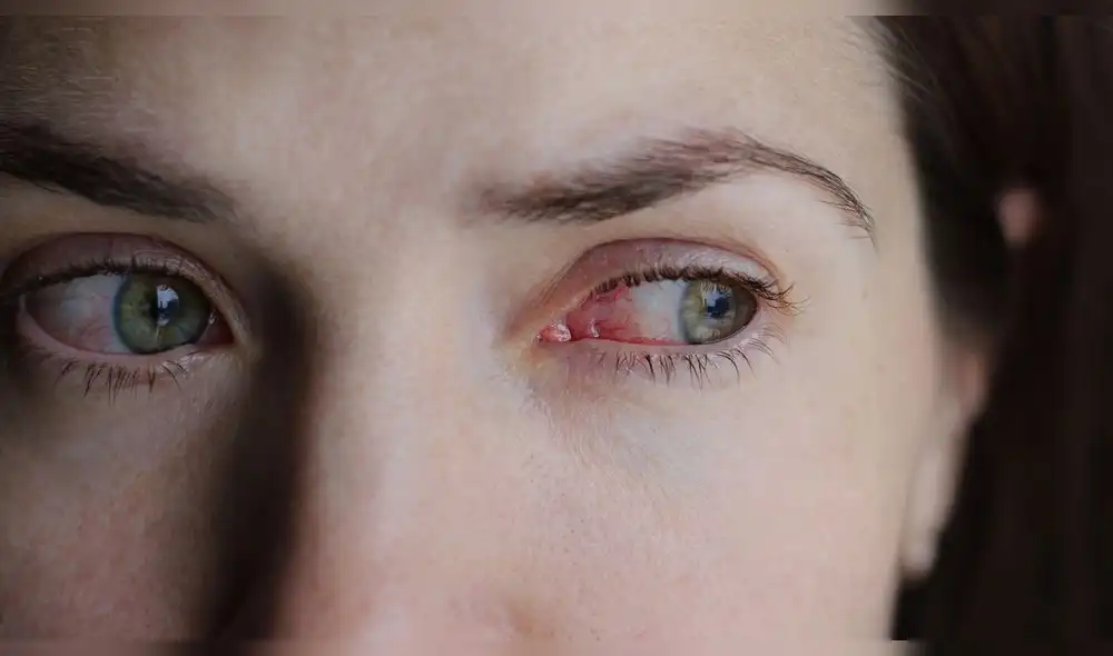 ¿Por qué aparecen legañas en los ojos?