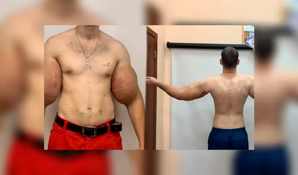 ‘Popeye ruso’ se somete a cirugía y médicos le sustraen el doloroso líquido de sus bíceps ‘Popeye ruso’ se somete a cirugía y médicos le sustraen el doloroso líquido de sus bíceps