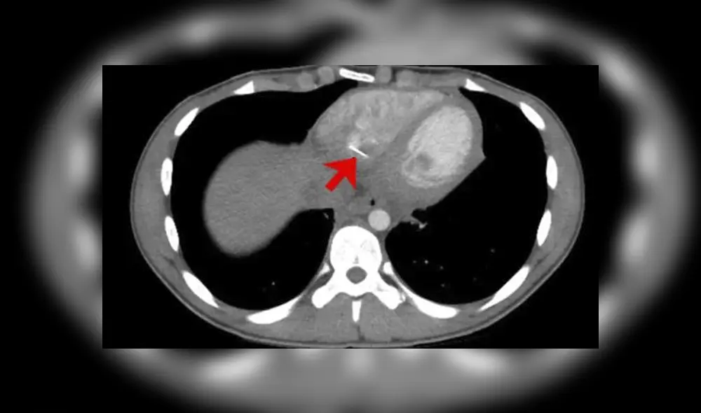 Los médicos llevaron a cabo una cirugía para extraer el objeto alojado en el corazón del menor. Foto: Mathews.