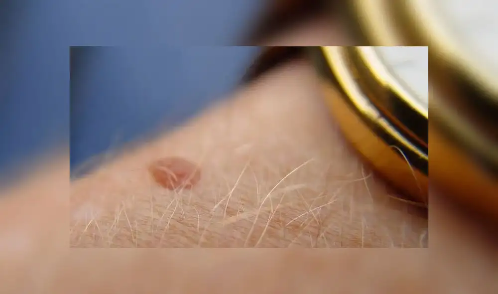 Día del Lunar: ¿cómo detectar y prevenir a tiempo las inusuales manchas en la piel? Día del Lunar: ¿cómo detectar y prevenir a tiempo las inusuales manchas en la piel?