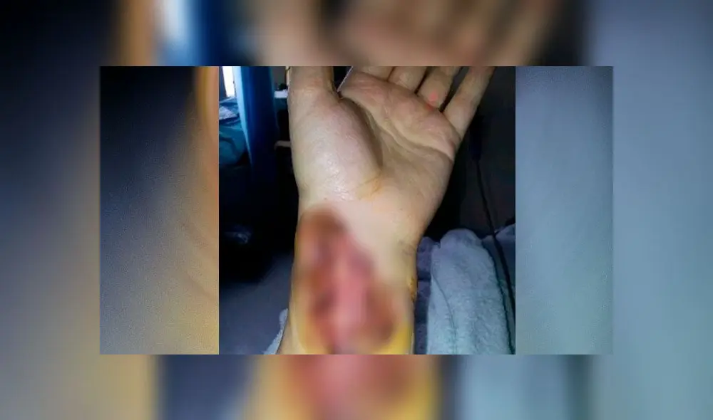Le extirparon parte de su lengua por un cáncer y ahora tiene una nueva hecha con piel de su brazo