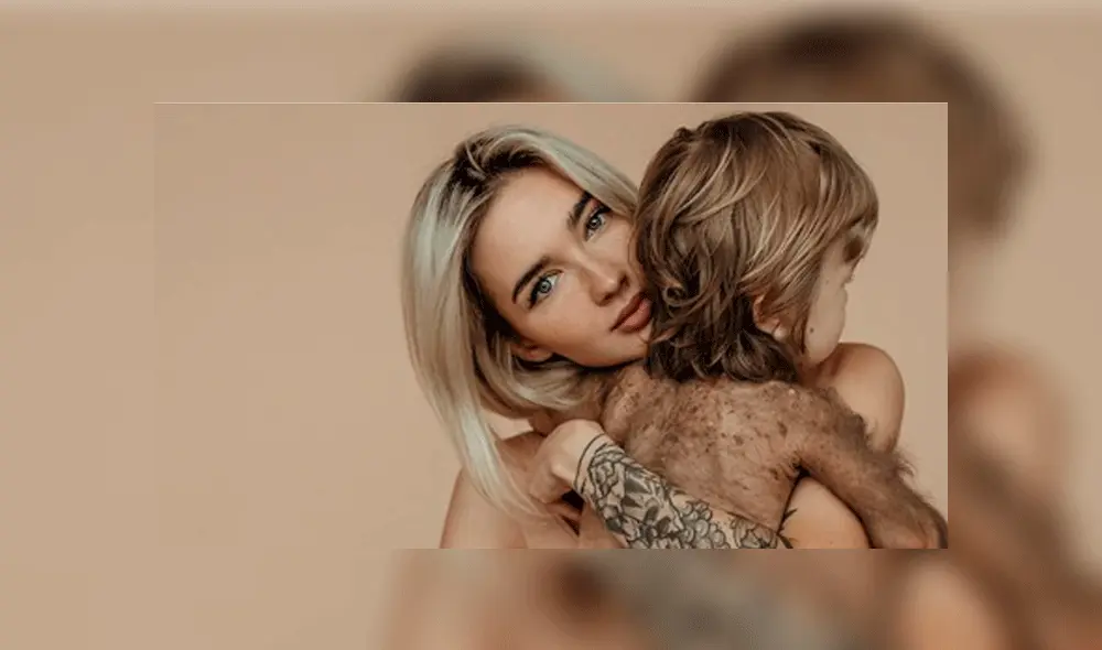 Bebé nace con extraña enfermedad en la piel y su madre influencer lo presume con orgullo [FOTOS]