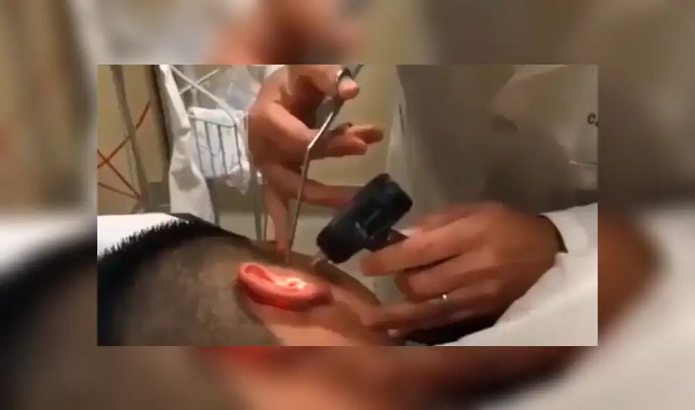 Facebook viral: nunca imaginarás la aterradora criatura que encontró este joven dentro de su oído [VIDEO] 